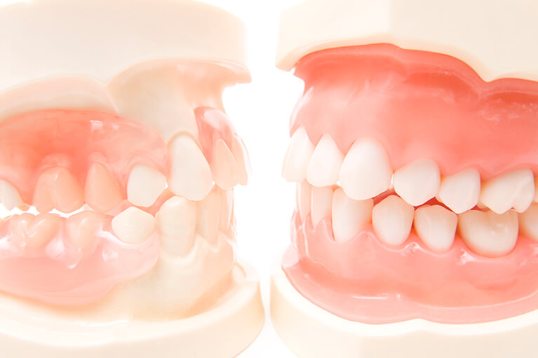歯並び、顎関節症について